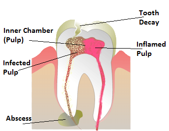 tooth abscess infection abscessed does dental jaw spread bone occur illustration loss