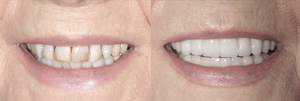 Mal-aligned teeth