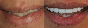 Stained, discolored or yellow teeth