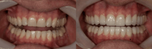 Teeth that are too small