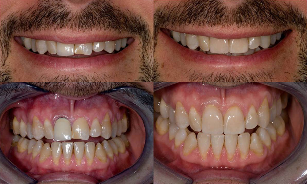Dental Crowns in Irvine - Irvine CA Tooth Crowns - Teeth Caps Irvine  California
