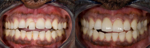 Before and after dental implant surgery in Irvine, CA