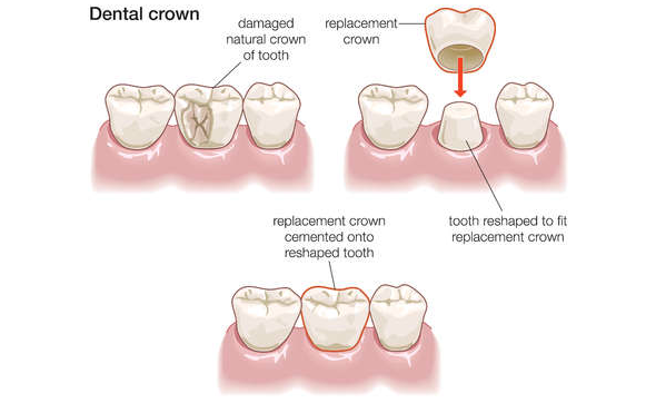 Irvine Dental Crowns