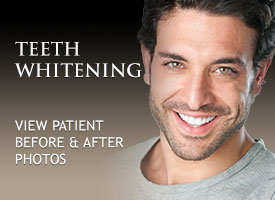 Teeth Whitening Orange County • Professional Teeth Whitening Orange