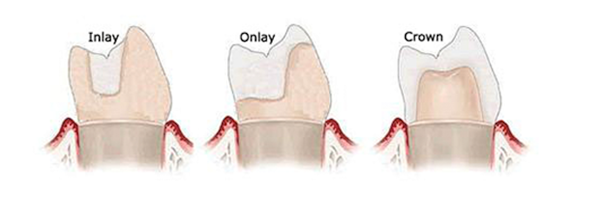 Dental Onlays in Irvine - Tooth Onlay Irvine CA - Partial Crowns ...