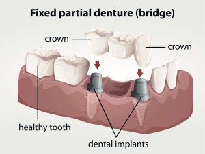 Dental Bridges Irvine