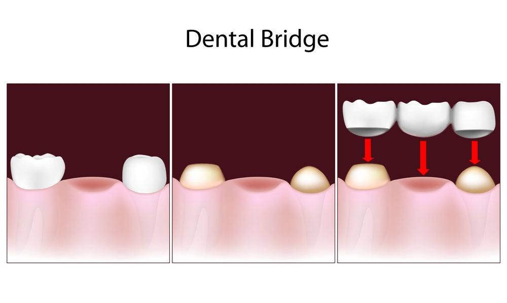 Irvine Dental Bridges