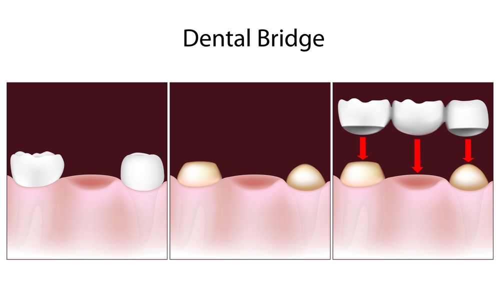 bridges dental cantilever bonded resin traditional bridge