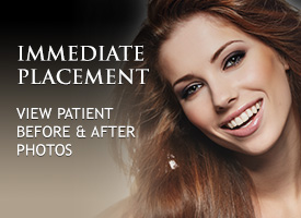 Immediate Placement of Dental Implants in Irvine