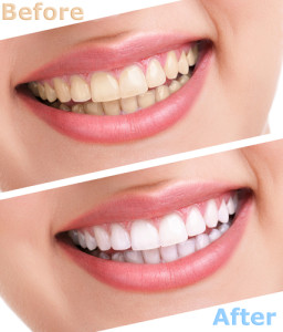 Before and after photo of teeth whitening