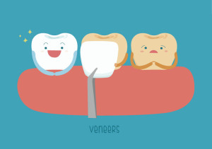 Cartoon drawing of three teeth, one of which is wearing a veneer