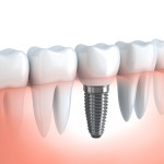 Illustration of five teeth in the gums, the middle of which is an implant