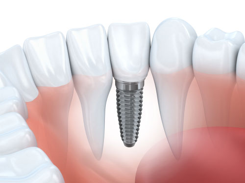 Dental Implants Newport Beach Illustration