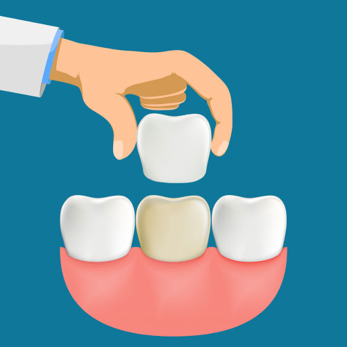 Placing a Porcelain Veneer