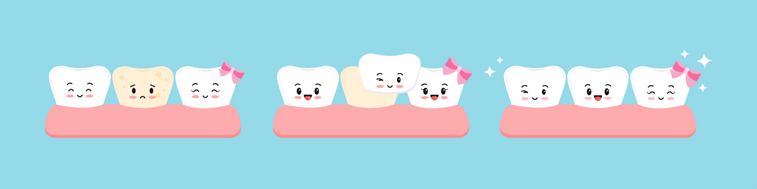 Replacing Porcelain Veneers Illustration