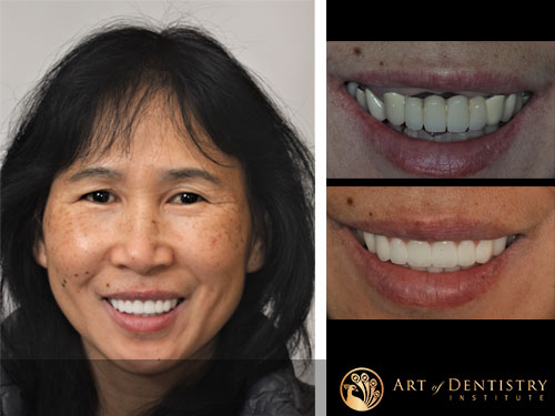 Irvine Dental Implants Before After Third Example