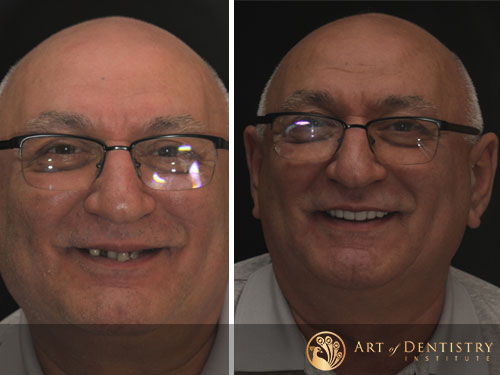Irvine Dental Implants Before After Second Example
