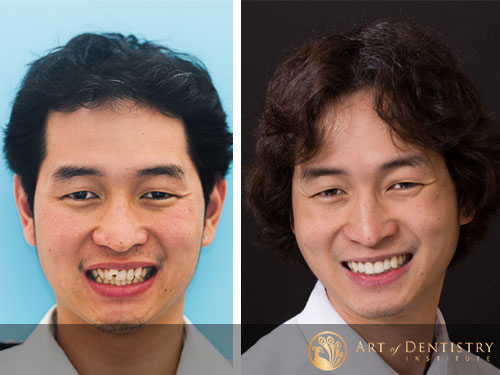Invisalign Patient Before and After