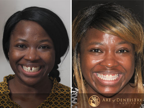 Invisalign Procedure Before and After