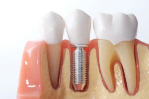 Dental Implants Cost in Newport Beach