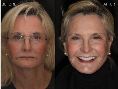 Age Defying Dentistry Patient 1