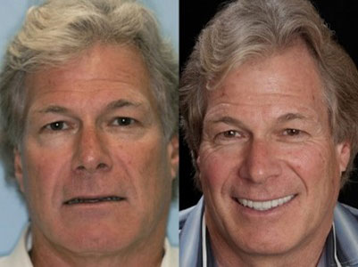 Age Defying Dentistry Patient 2