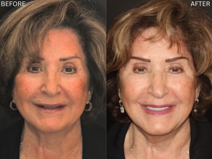 Age Defying Dentistry Patient 3