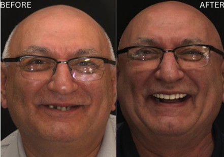 Age Defying Dentistry Patient 4