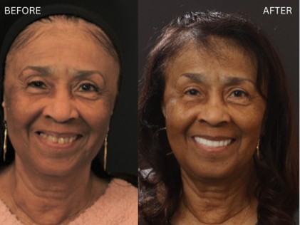 Age Defying Dentistry Patient 5