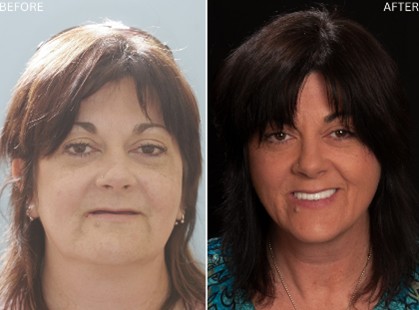 Age Defying Dentistry Patient 6