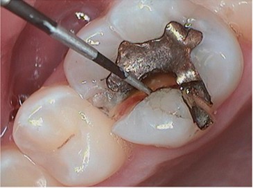 Amalgam Filling