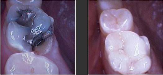 Amalgam Filling Correction