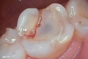Posterior White Filling