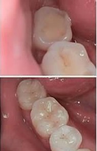 Posterior White Filling Correction