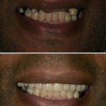 Implant case 21 (No Face) thumbnail