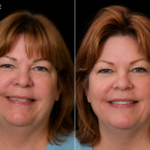 Anti Aging 32 thumbnail