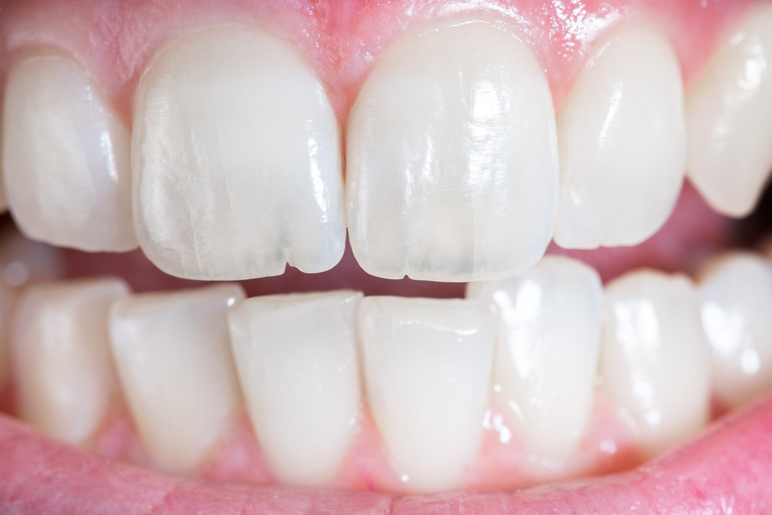 Chipped teeth in need of cosmetic dental work.