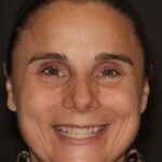 Smile Gallery 12/ Full Mouth Rehab 48 thumbnail