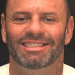 Smile Gallery 17/ Full Mouth Rehab 45 thumbnail