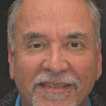 Smile Gallery 4/ Full Mouth Rehab 18 thumbnail