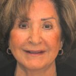 Smile Gallery 16/ Full Mouth Rehab 44 thumbnail