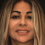 Smile Gallery 21/ Full Mouth Rehab 23 thumbnail