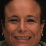 Smile Gallery 7/ Full Mouth Rehab 38 thumbnail