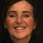 Smile Gallery 5/ Full mouth Rehab 12 thumbnail