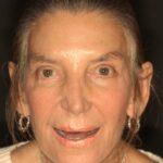 Smile Gallery 10/ Full Mouth Rehab 13 thumbnail