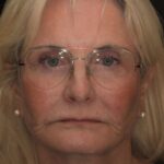 Shauna L Smile Gallery 2/ Full Mouth Rehab 22 thumbnail