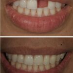 Implant Case 20 ( No face) thumbnail