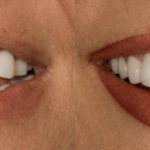 Case 11 (no Face Implant) thumbnail