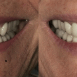 Implant case 12 (No Face) thumbnail