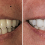 Implant case 13 (No Face) thumbnail